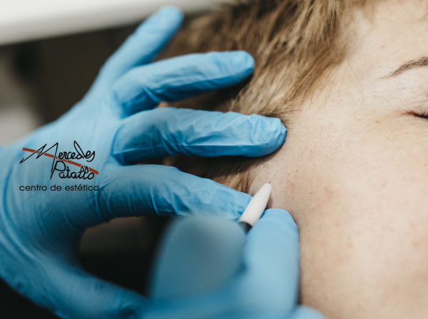 Depilación eléctrica facial en Centro de Estética en Gijón Mercedes Patallo
